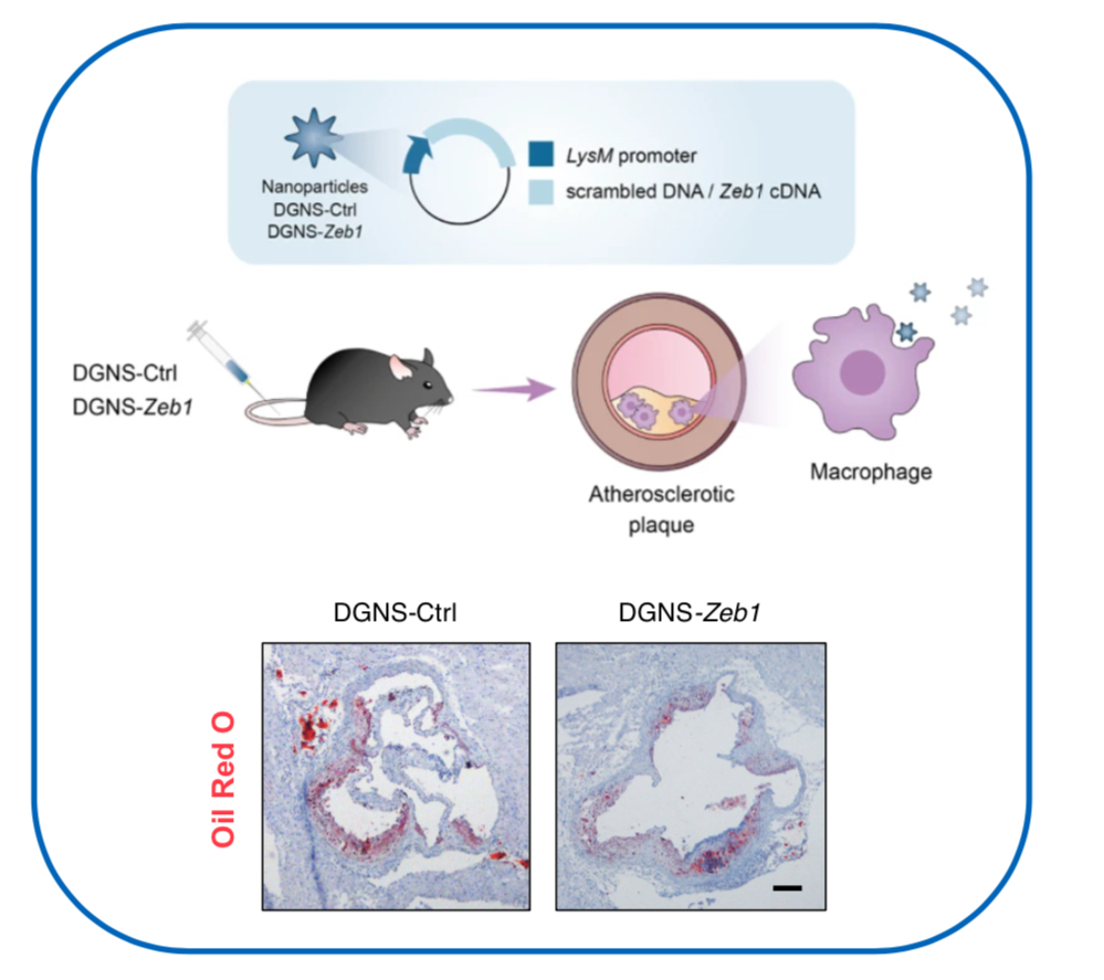 Regulation of Cell Plasticity Group (@genereglab) on Twitter photo 🚨
🔥📰 in <a href="/NatureComms/">Nature Communications</a> by 👩🏻🔬<a href="/MCMartinezCamp/">MC Martinez Campanario</a>
Full text ➡️t.ly/KFayz
🔴#ZEB1 in #macrophages reduces #atherosclerosis development & systemic #metabolism dysregulation
🔴ZEB1 delivery via macrophage-targeted #nanoparticles reduces atherosclerosis #plaque 🚨
🔥📰 in <a href="/NatureComms/">Nature Communications</a> by 👩🏻🔬<a href="/MCMartinezCamp/">MC Martinez Campanario</a>
Full text ➡️t.ly/KFayz
🔴#ZEB1 in #macrophages reduces #atherosclerosis development & systemic #metabolism dysregulation
🔴ZEB1 delivery via macrophage-targeted #nanoparticles reduces atherosclerosis #plaque