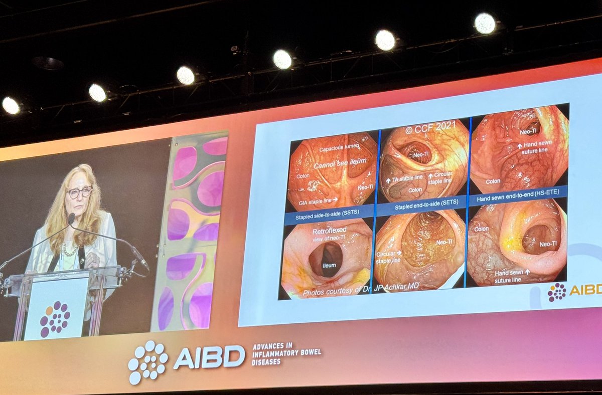 Top 5 #IBDSurgery articles from @drtracyhull at #AIBD2023 inc. LIR!C early ileocolic resection, SUPREME-CD on Kono-S, #IBD patient POV on surgery, QoL after redo #IPAA, & outcomes of redo pouch after MIS #IPAA #SoMe4IBD #SoMe4Surgery