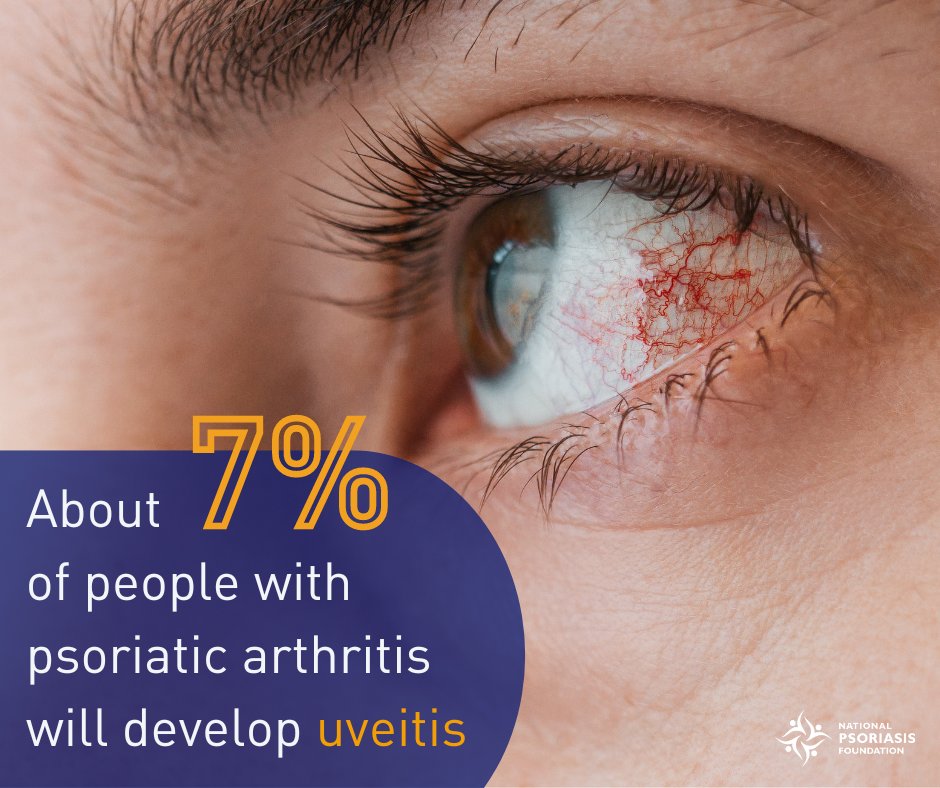 Uveitis (pronounced “you-vee-EYE-tis”), is a medical term referring to several different diseases related to inflammation within the eye. Head to our website to learn about about what your eyes could tell you about your joints 🔗 psoriasis.org/advance/eye-in…