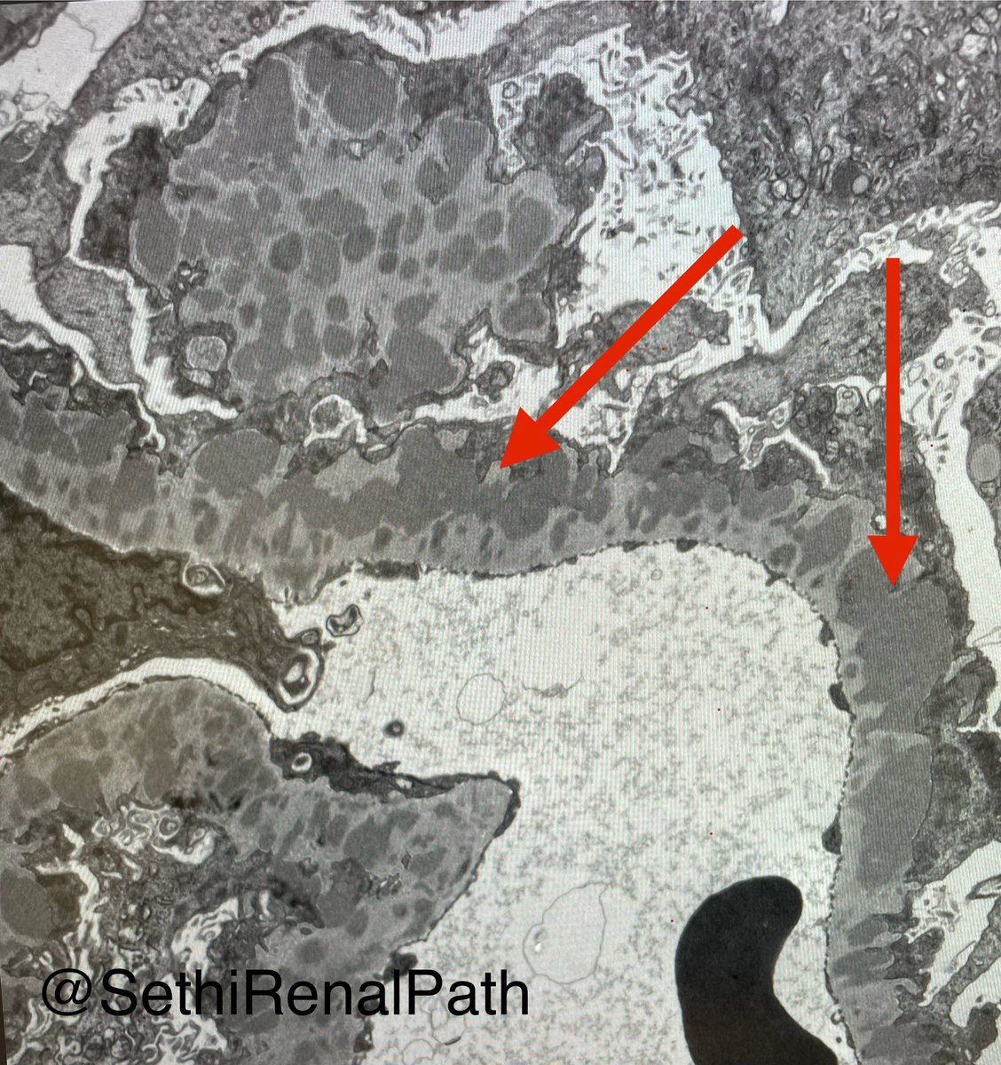 SethiRenalPath tweet picture