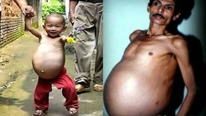 Sanju Bhagat's stomach was so swollen he looked nine months pregnant, and his breathing was so bad that he was rushed to hospital. Doctors suspected his enlarged abdomen was a tumor until they opened him up and found that he'd been carrying around his absorbed twin for 36…