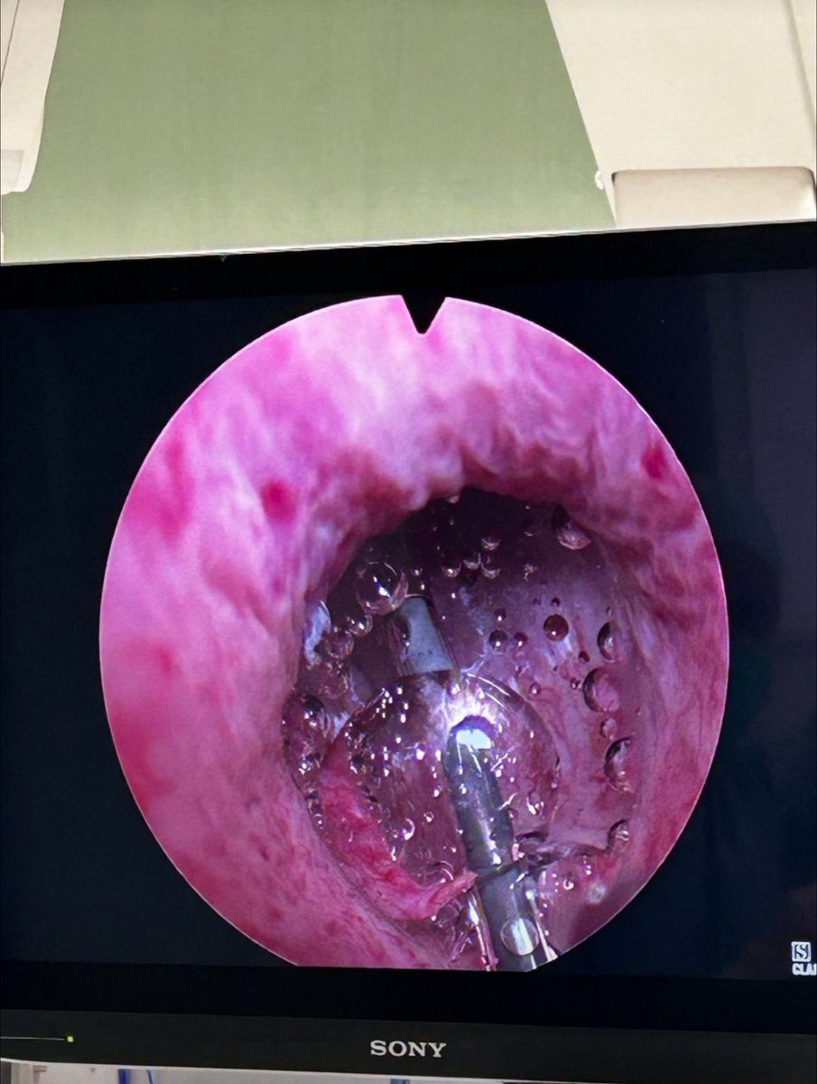 Luciano Ola (@luciano_ola_md) on Twitter photo Today, we conducted our first Optilume session, placing three devices in patients with a history of recurrent urethral strictures.
Thank you #ACTAGroup for the kind collaboration. <a href="/DavideVagnini/">Davide Vagnini</a>
<a href="/OspedaleCuneo/">OSP. S. CROCE CUNEO</a>
<a href="/IvanoMorra/">Ivano Morra</a>
<a href="/dalmetto/">Ettore Dalmasso</a>
<a href="/FilippoPoletti/">Filippo Poletti</a> Today, we conducted our first Optilume session, placing three devices in patients with a history of recurrent urethral strictures.
Thank you #ACTAGroup for the kind collaboration. <a href="/DavideVagnini/">Davide Vagnini</a>
<a href="/OspedaleCuneo/">OSP. S. CROCE CUNEO</a>
<a href="/IvanoMorra/">Ivano Morra</a>
<a href="/dalmetto/">Ettore Dalmasso</a>
<a href="/FilippoPoletti/">Filippo Poletti</a>