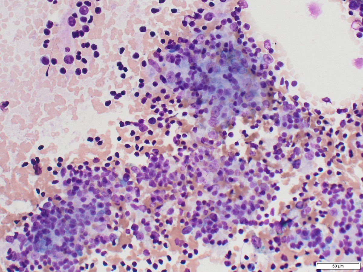 Classic cytomorphology in this case of EBUS-FNA for mediastinal lymphadenopathy for #FNAFriday.