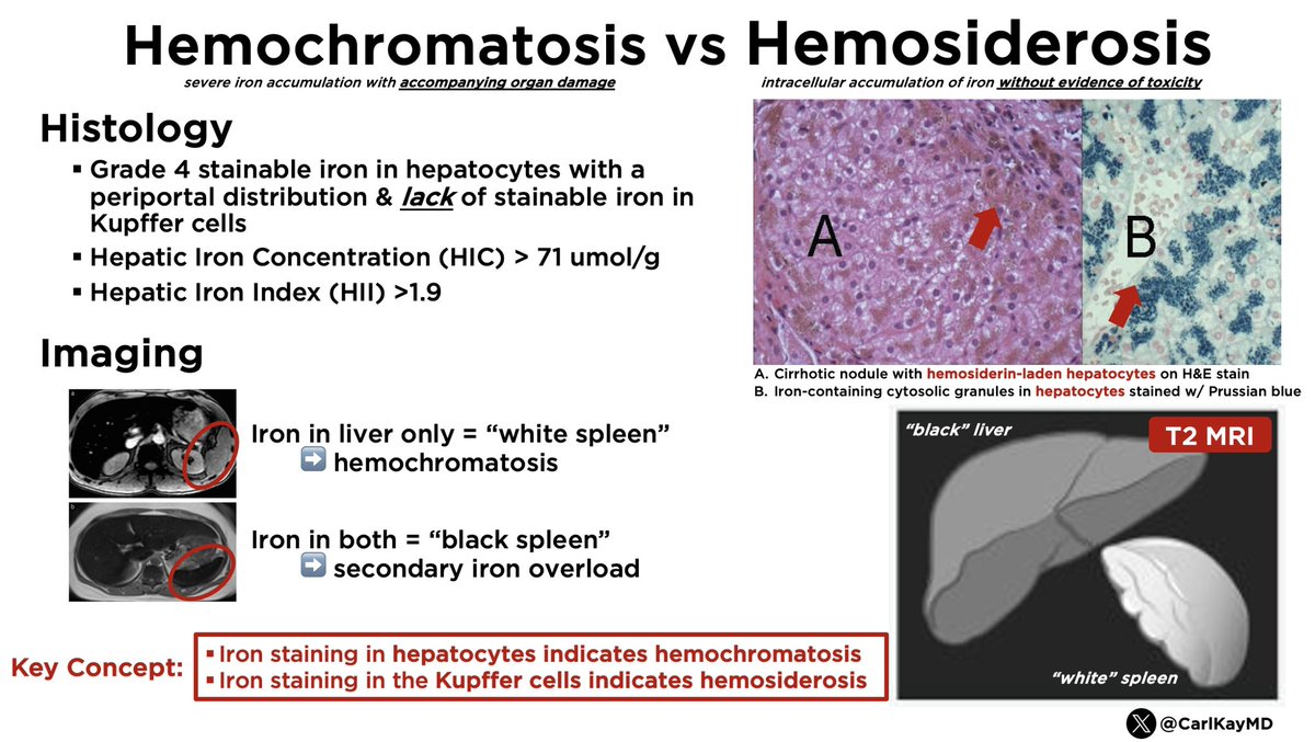 Hemochromatosis vs Hemosiderosis Hemochromatosis ▪️Iron accumulation + organ damage ▪️Iron in hepatocytes ▪️Lack of stainable iron in Kupffer cells ▪️HIC >71 umol/g or HII > 1.9 Hemosiderosis ▪️Iron accumulation without toxicity ▪️Iron in Kupffer cells #LiverTwitter 👊