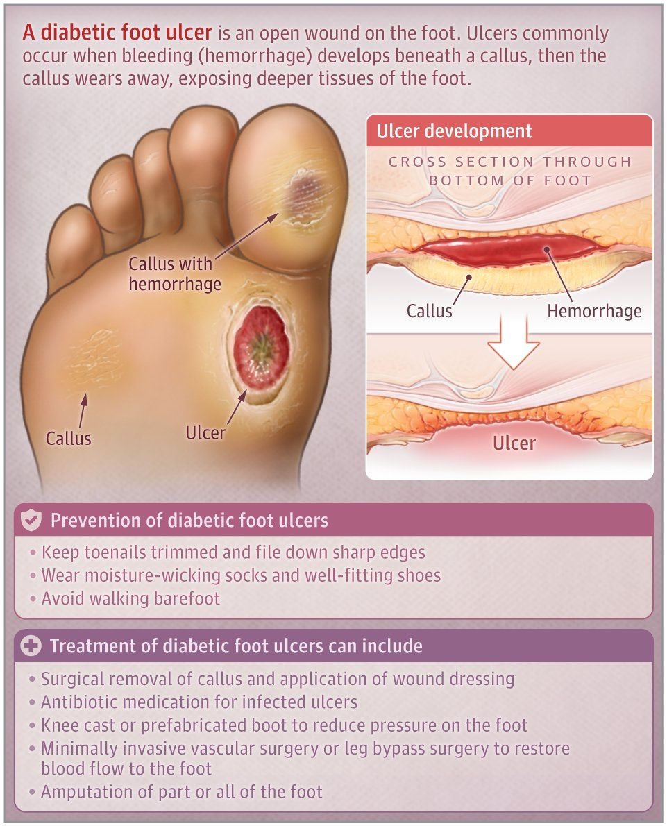JAMA Patient Page: Diabetic Foot Ulcers diabeticfootonline.com/2023/11/19/jam…