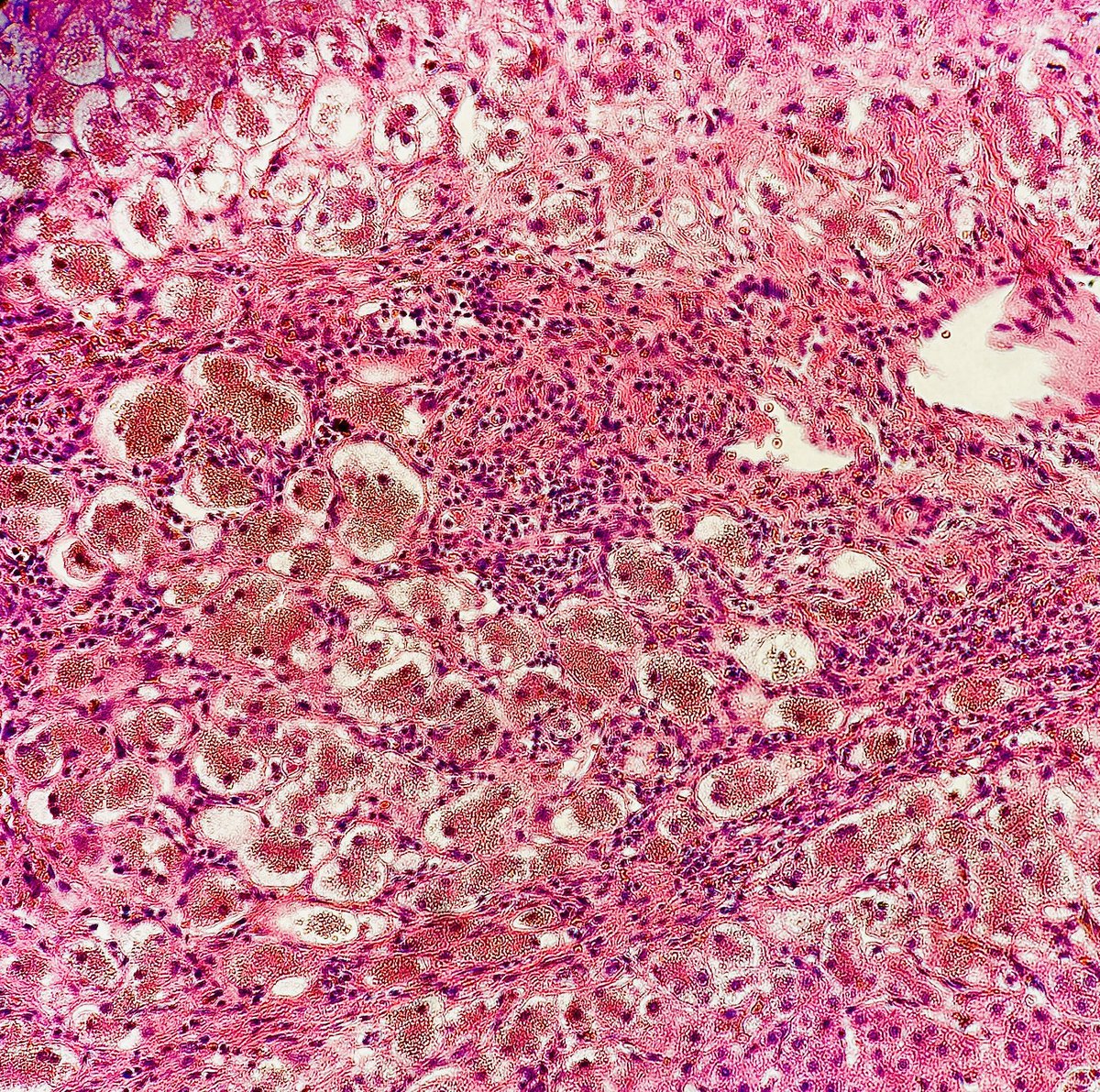 Infant with jaundice, constant itching and failure to thrive

He has elevated GGT and has a pansystolic murmur. Liver sample shown below👇 

Genetic testing: JAG1 mutation 

Dx?

Credit: Dr. Robert Brady 

#pathagonia #pathx #pedsx #medx #medicalstudents #genetics #gipath #surgx