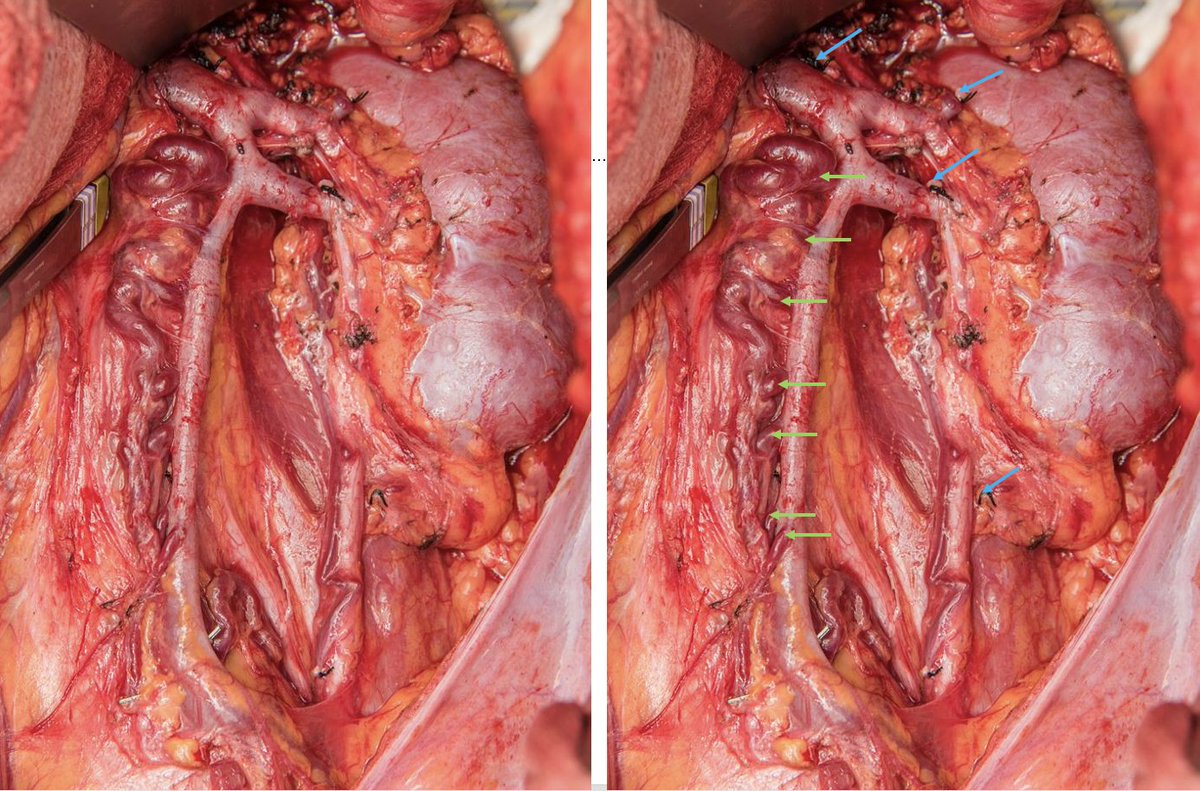 Beautiful anatomy of Nutcracker syndrome. Note the dilated renal vein, number and engorgement of collaterals (green arrows) and already taken collaterals with silk ties (blue arrows) #NutcrackerSyndrome #LeftLoinPain #VascularSurgery @VascularSVS @CleClinicUro @AmerUrological