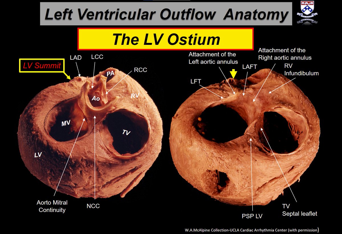 Learning cardiac anatomy from the best! Anatomy is the key to EP. @DrFerminGarcia #EPeeps @PennCardiology