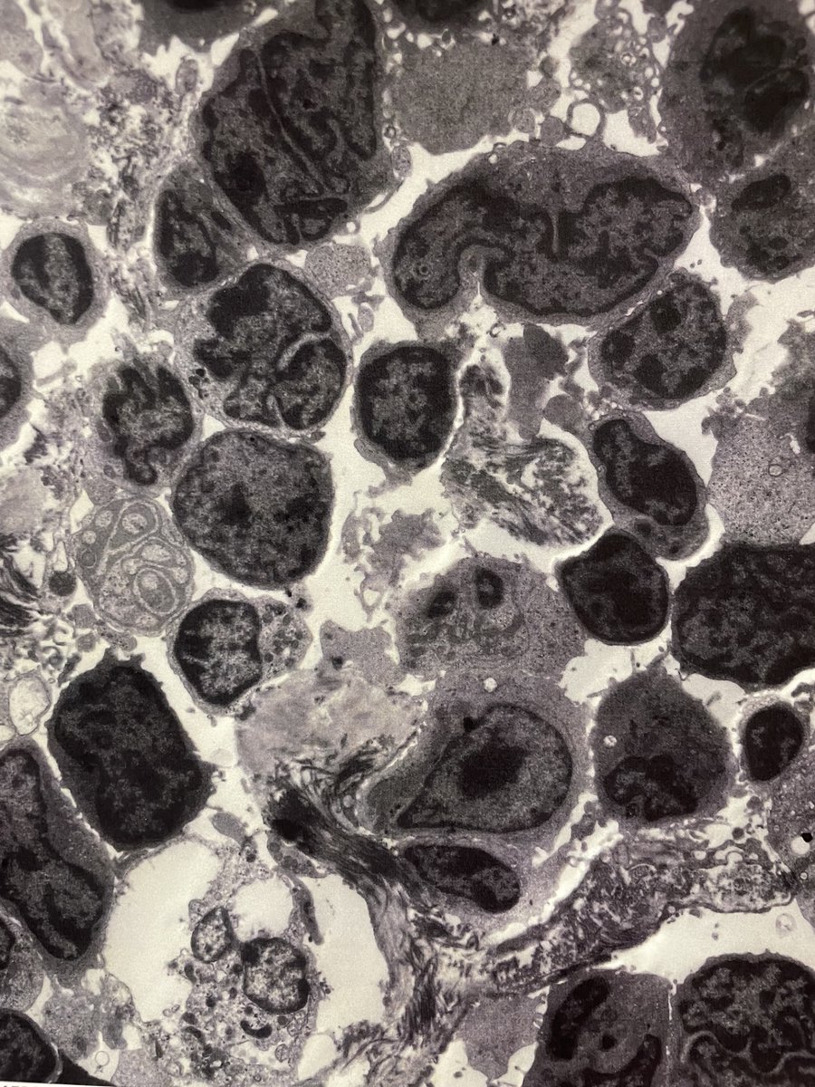 Not often you get to see lymphoma on electron microscopy. This medical renal biopsy was involved by a follicular lymphoma (it lacked the usual architecture but had the same immunotype as the pt's known lymphoma). #Hemepath #PathTwitter #PathX