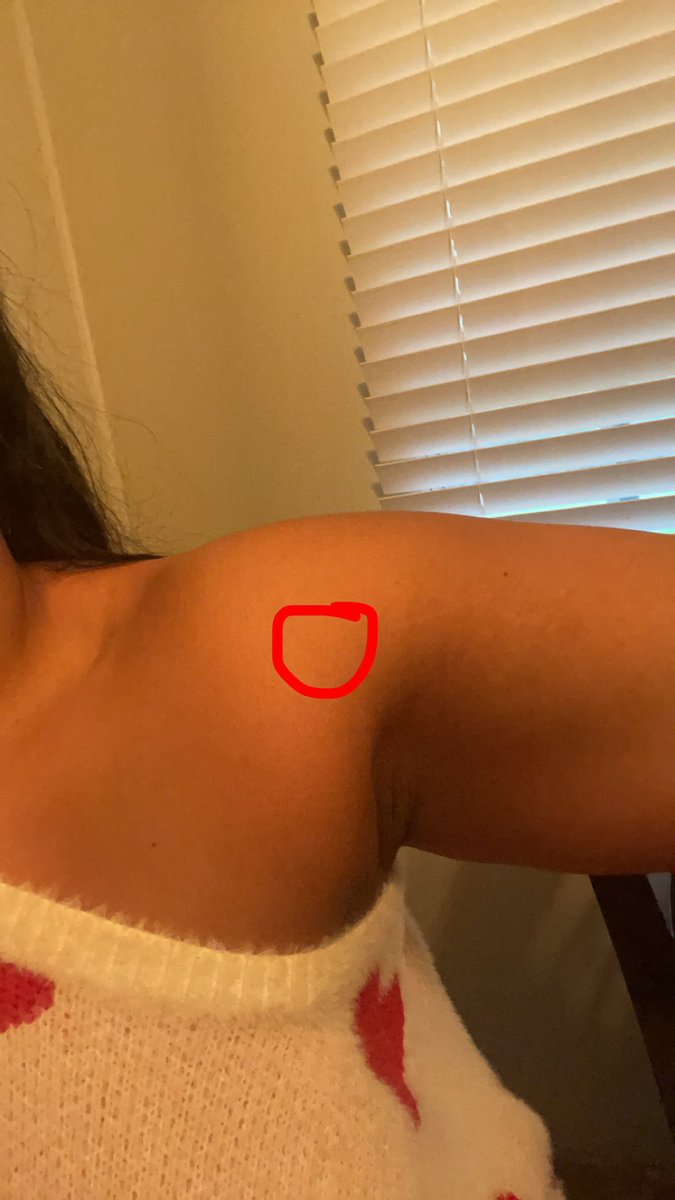 Dealing with this persistent shoulder pain for months now. 🤔 Some of you might already know about it. The uncertainty is tough, but I appreciate the support. Here's a snapshot of the spot that's been bothering me. What should I do? #ShoulderPain #HealthJourney