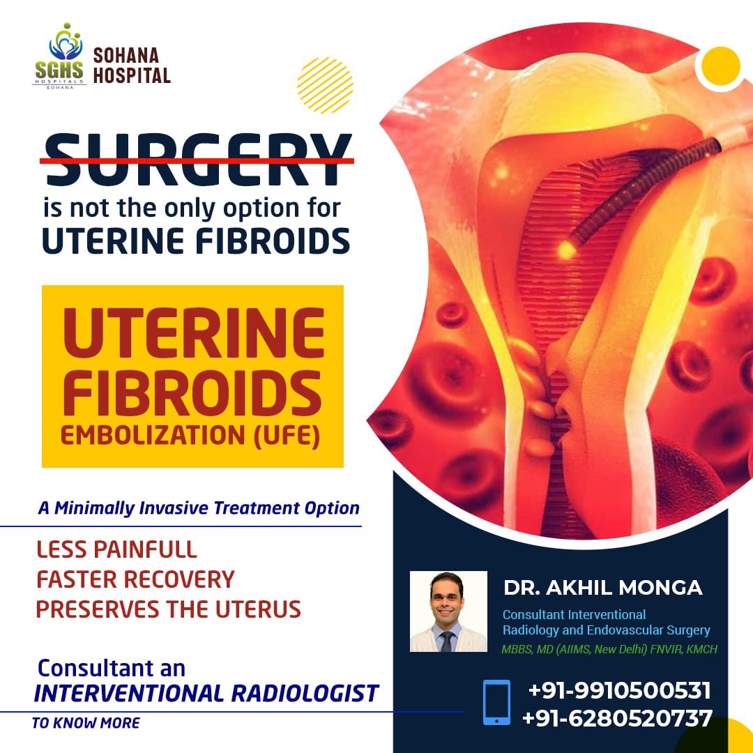 An extremely effective and simple option for menorrhagia and dysmenorrhea due to uterine fibroids and Adenomyosis. Almost 10 % of the women population suffering from fibroid related symptoms. Few are aware about this option! @ISVIRIndia @ISVIRJUNIORWING @fogsiofficial