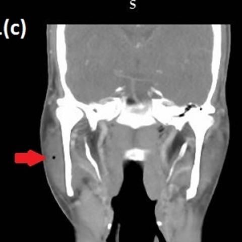 Our featured #EuroRad case brings a 44-year-old male, contrast-enhanced CT face & neck evaluated biopsy-proven squamous cell carcinoma of right cheek. Ill-defined patch of leukoplakia w/ crepitus over right preauricular & parotid regions. Read more: buff.ly/404uVOW