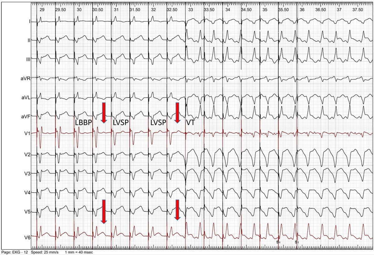 Is LVSP proarrhythmic while His-Purkinje Pacing is not? Transition to LVSP immediately induced VT; several other VT episodes induced by myo but not by HPP. #EPeeps @Hisdoc1 @curilakarol @DrRoderickTung @OCanoPerez related to DOI: 10.1161/CIRCULATIONAHA.123.067465 ?