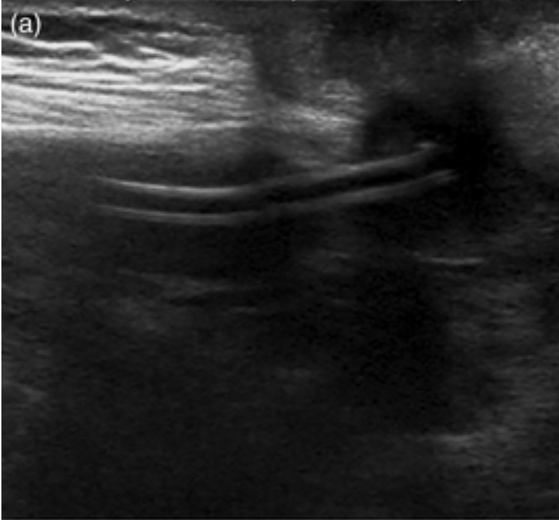 15 month old presents to their doctor with a draining belly button for 1 YEAR
Surgeons pull 6 cm of a broken UVC out $ #pedsurg to the rescue
Reminder to inspect your lines on removal...every time!
onlinelibrary.wiley.com/doi/epdf/10.11…
#neoTwitter #pediatricsurgery