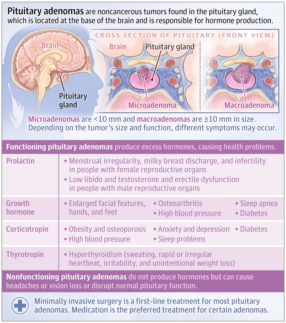 JAMA (@jama_current) on Twitter photo A pituitary adenoma is a tumor in the pituitary gland, located at the base of the brain. This JAMA Patient Page discusses types and symptoms, diagnosis, and treatment of pituitary adenomas. ja.ma/41iMM5L A pituitary adenoma is a tumor in the pituitary gland, located at the base of the brain. This JAMA Patient Page discusses types and symptoms, diagnosis, and treatment of pituitary adenomas. ja.ma/41iMM5L