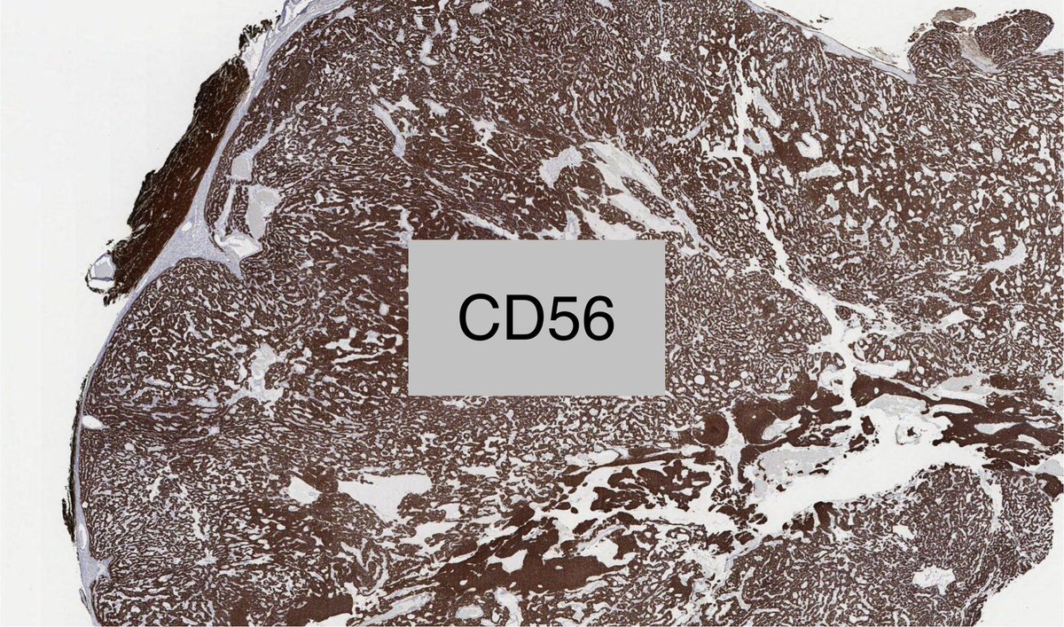 Consider GLI1-altered mesenchymal tumor with malignant potential  

👀 
->multinodular growth of nested uniform ovoid cells w fibrous septa, myxoid stroma and delicate capillary vasculature 
->CD56,S100 +
->no clear line of differentiation

Kerr et al,Mod Pathol2024 <a href="/darcykerrMD/">Darcy A. Kerr</a>