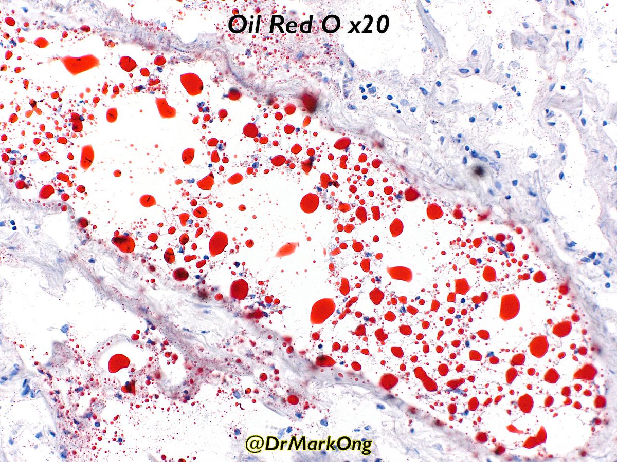 Fat embolism syndrome which didn't end well.

#autopsypathology #ForensicPath #pathology