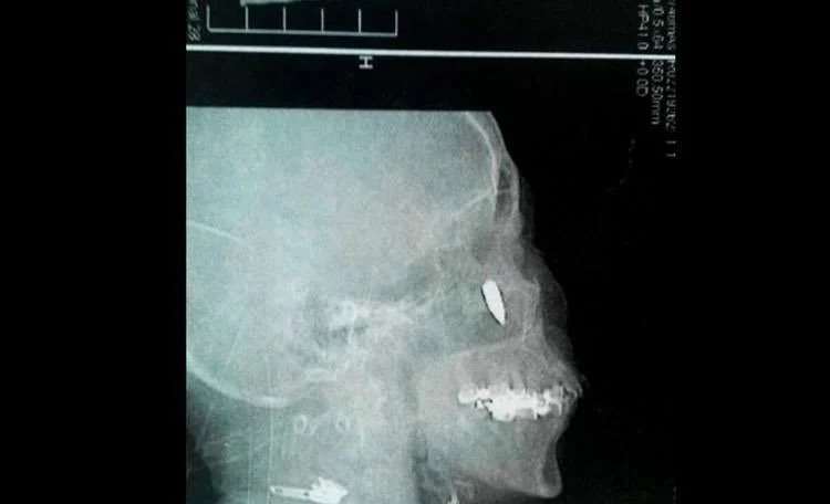 A Chinese woman with chronic rhinitis was suffering from headaches and breathing issues. An exploratory x-ray revealed a bullet lodged in her head by her nostril. 

She then remembered back 48 years ago to when she was 14, and walking along a path. The woman felt a stinging pain