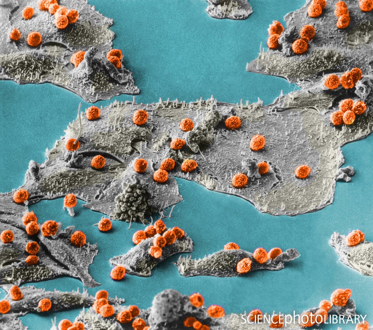 This SEM shows a battlefield, with immune cells (small sphericals, red) attacking cancer cells (larger bodies, grey). 

Credit: Science Source / Science Photo Library
bit.ly/2RFepT8
#cancer #immunecells #whitebloodcells #sciart