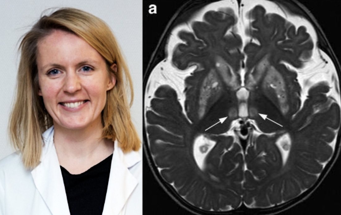 IDKD (@idkdcourse) on Twitter photo Check-out this review about "Bilateral lesions of the basal ganglia and thalami" coauthored by Prof. Sofie Van Cauter. Prof. Van Cauter will be part of our IDKD faculty in Davos and with the topic "Toxic and metabolic disorders". ncbi.nlm.nih.gov/pmc/articles/P……
<a href="/NRADjournal/">Neuroradiology</a>
#IDKD2024 Check-out this review about "Bilateral lesions of the basal ganglia and thalami" coauthored by Prof. Sofie Van Cauter. Prof. Van Cauter will be part of our IDKD faculty in Davos and with the topic "Toxic and metabolic disorders". ncbi.nlm.nih.gov/pmc/articles/P……
<a href="/NRADjournal/">Neuroradiology</a>
#IDKD2024
