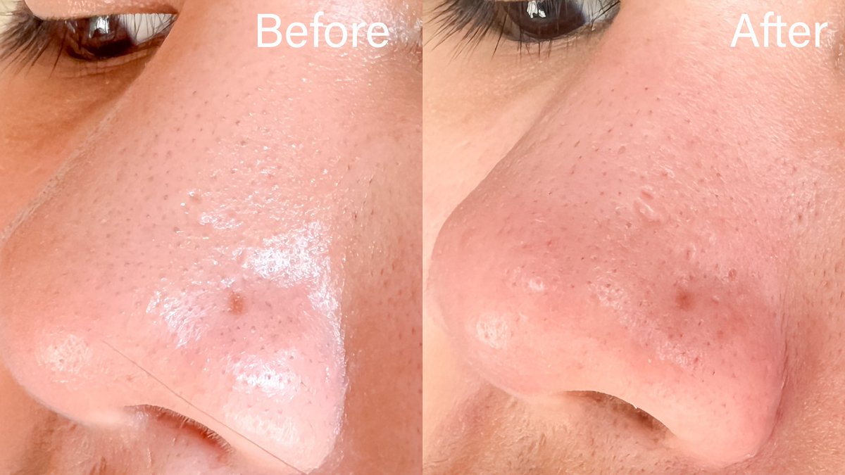 ต้องแนะนำจริงๆ #เครื่องดูดสิวเสี้ยน facefactory ตัวดังจากเกาหลีมีขายที่ไทยละ ใช้ง่ายเว่อถูวนๆบริเวณที่มีสิวเสี้ยนได้เลย แถมยังเลือกปรับระดับความแรงได้ด้วย ไม่ว่าจะตรงไหนก็ดูดออกได้หมด ขนาดปีกจมูกยังเอาอยู่ ตอนนี้สิวเสี้ยนแทบไม่เหลือแล้วจ้า เลิฟฟ🫶🏻
#ใช้ดีบอกต่อ #facefactory_th