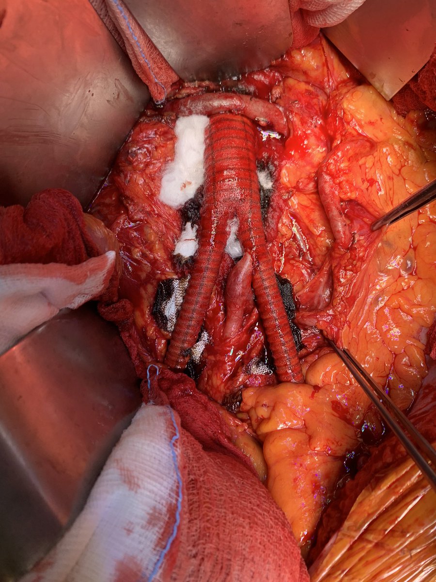 Hypertrophic Riolano’s in Rutherford III 4. #veterosurgey #aortaed