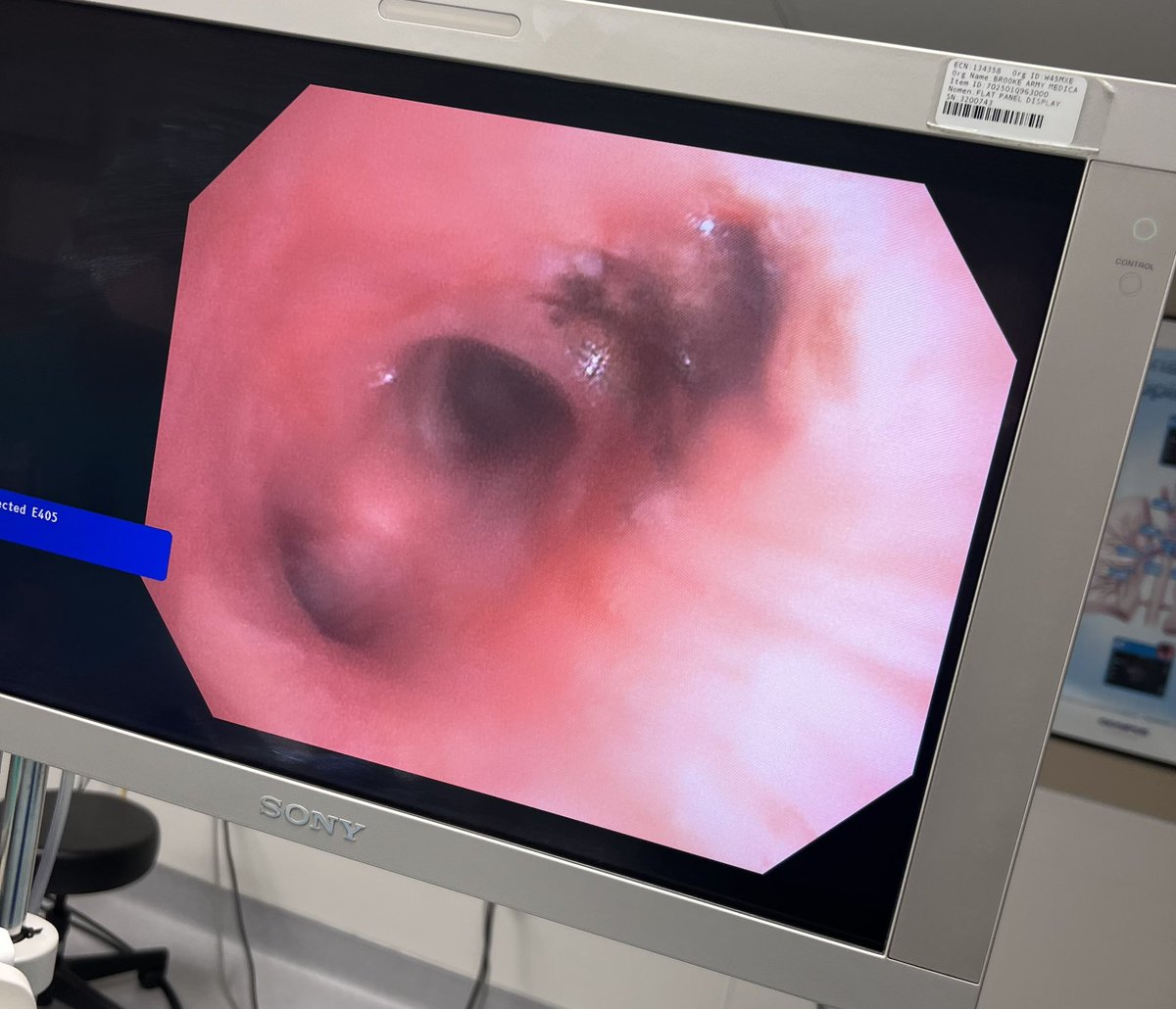 JBosterMD's tweet photo. Classic case! Not all that wheezes is asthma. @AAB_IP #Interventionalpulm https://t.co/bSYrGOdvTt