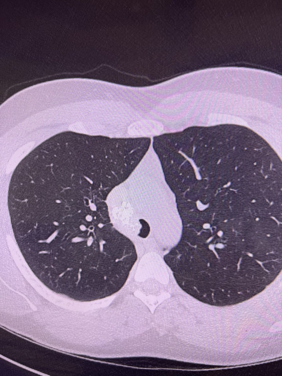 JBosterMD's tweet photo. Classic case! Not all that wheezes is asthma. @AAB_IP #Interventionalpulm https://t.co/bSYrGOdvTt