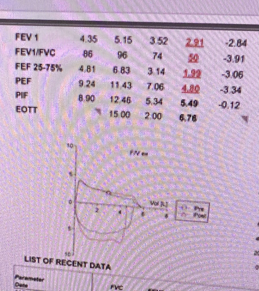 JBosterMD's tweet photo. Classic case! Not all that wheezes is asthma. @AAB_IP #Interventionalpulm https://t.co/bSYrGOdvTt