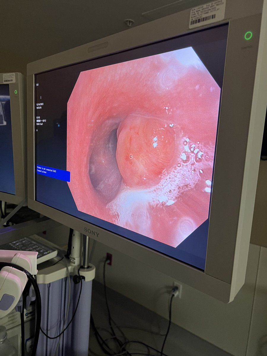 JBosterMD's tweet photo. Classic case! Not all that wheezes is asthma. @AAB_IP #Interventionalpulm https://t.co/bSYrGOdvTt