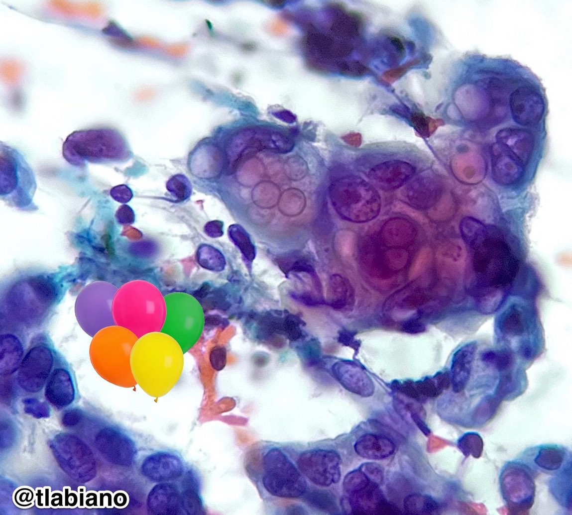 Tania Labiano (@tlabiano) on Twitter photo 🫧🛁🧼🫧🔬✨
Intracytoplasmic vacuoles of 🫁Lung adenocarcinoma on #EBUS #FNA #cytology
Happy birthday <a href="/Histopatolomon/">Pascual Meseguer</a> 🎈🎁!
#pathart #pulmpath #cytopath 🫧🛁🧼🫧🔬✨
Intracytoplasmic vacuoles of 🫁Lung adenocarcinoma on #EBUS #FNA #cytology
Happy birthday <a href="/Histopatolomon/">Pascual Meseguer</a> 🎈🎁!
#pathart #pulmpath #cytopath