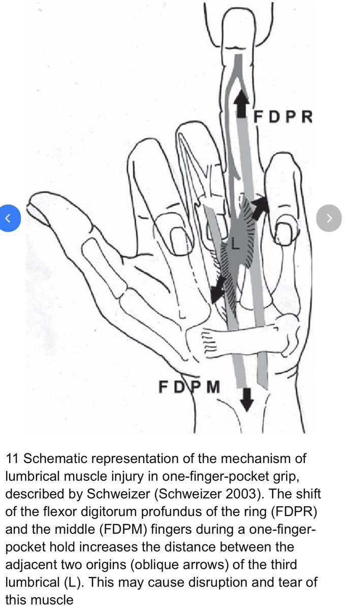 Lumbrical muscle tear. This type of tears typically occur after one-finger-pocket grip. Schematic representation from: link.springer.com/chapter/10.100… #mskrad #radres @SermeMsk