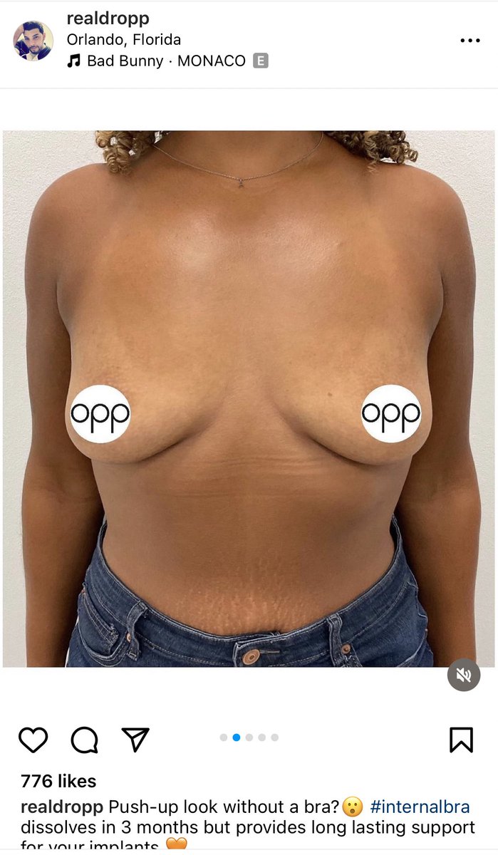 My favorite surgeon has done it again. BA with internal bra. Gorgeous work.