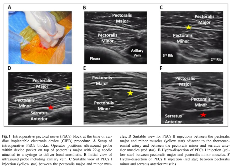 #EPeeps Your patients have pain after CIED procedures! Here is a novel approach to PECs blocks - performed within the device pocket at implant to reduce post-operative pain. Easy to add at the time of access @PennEPFellows @HRSonline @JICE_EP rdcu.be/dtQLR
