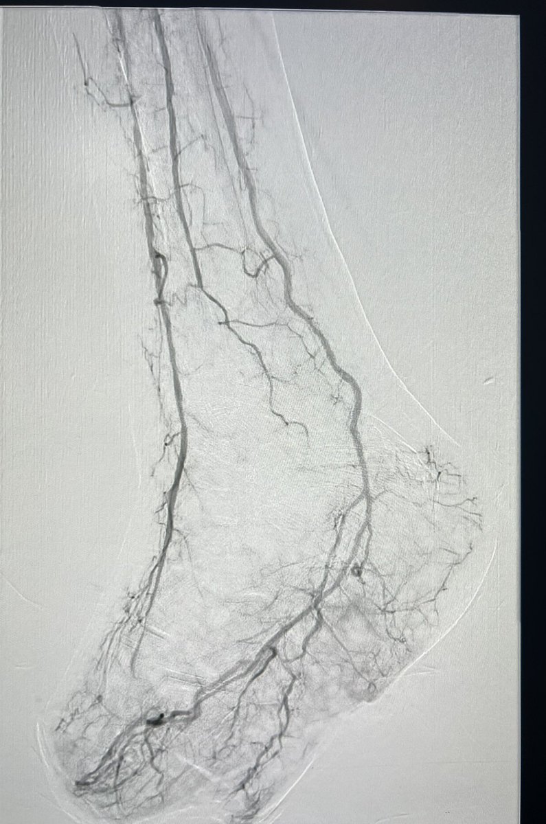 DrQahtani_MD's tweet image. Poor stump healing ,#CLI
#revascularization of popliteal, ATA , #angioplasty 
Good flow to the stump, time to heal👍
#irad
