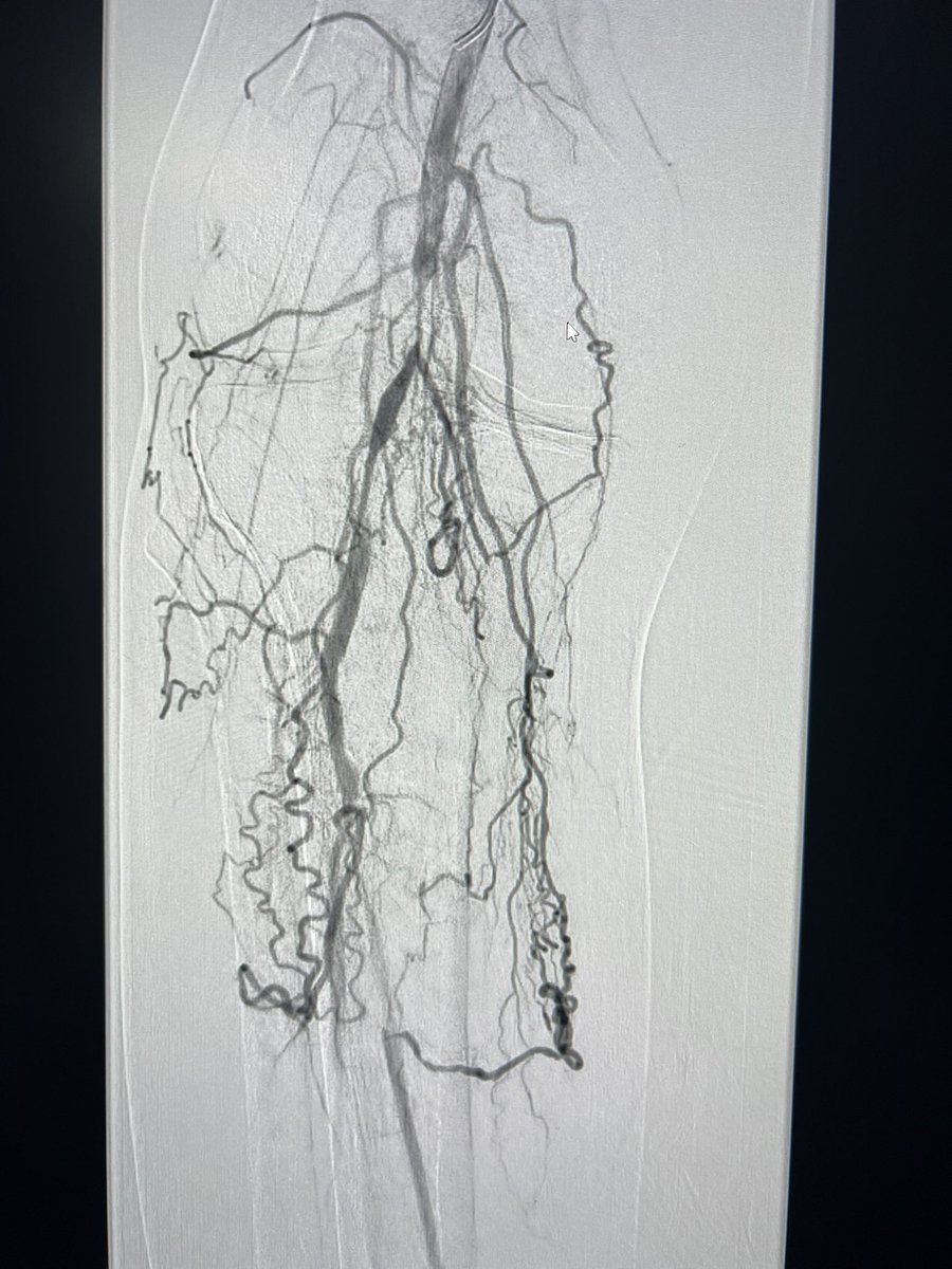 DrQahtani_MD's tweet image. Poor stump healing ,#CLI
#revascularization of popliteal, ATA , #angioplasty 
Good flow to the stump, time to heal👍
#irad