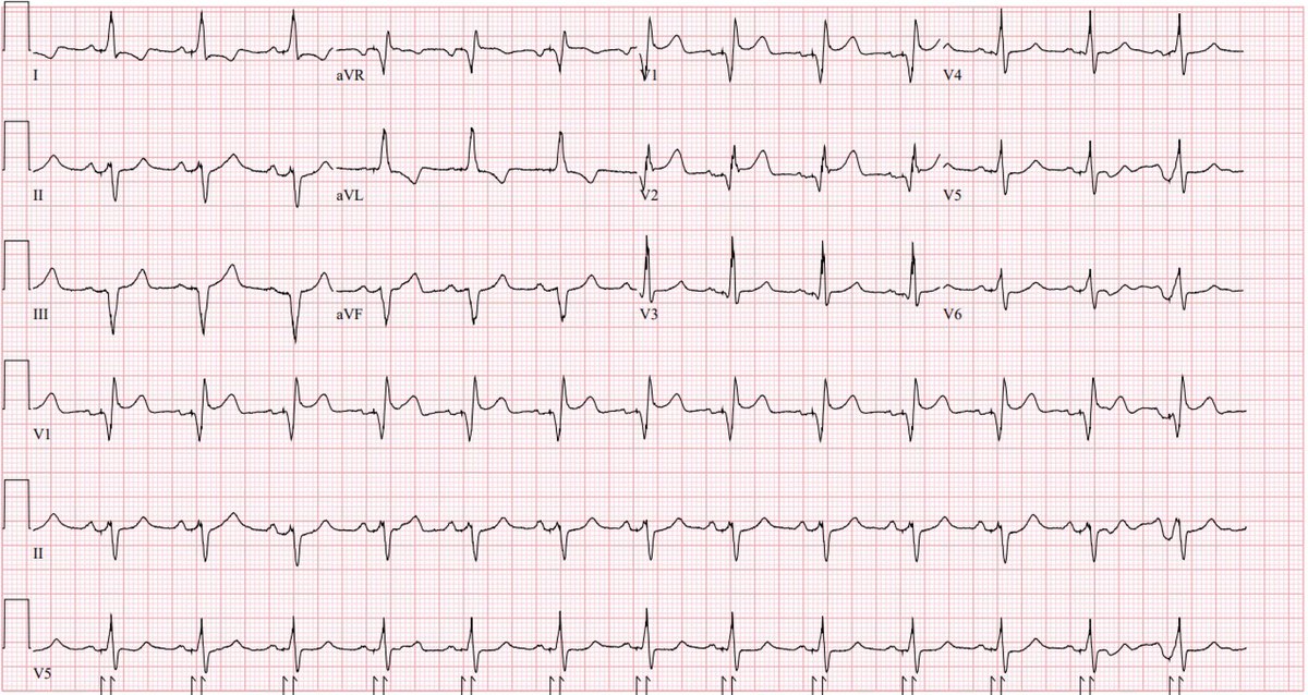 Not always excited about CRT for RBBB unless #conductionsystempacing can be used

#EPeeps #dontdisthehis #LBBpacing