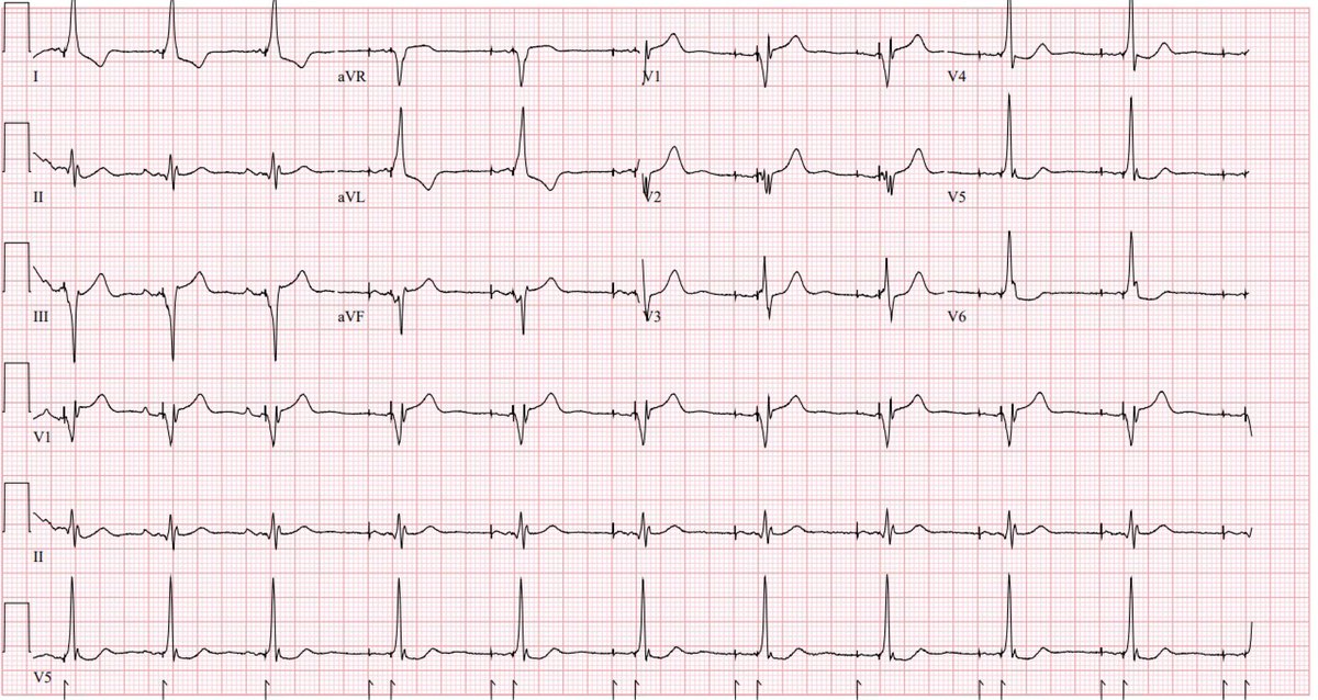 #conductionsystempacing #LBBpacing #dontdisthehis #EPeeps
