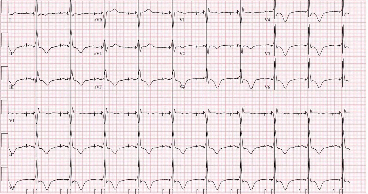 So is this #conductionsystempacing ? #EPeeps #LBBpacing #dontdisthehis

qR complex in V1 and V6-V1 interpeak interval >50 ms but QRSd is long and LVAT>80ms

Also S waves in V5/V6 and T wave memory suggest to me that LBB capture is present