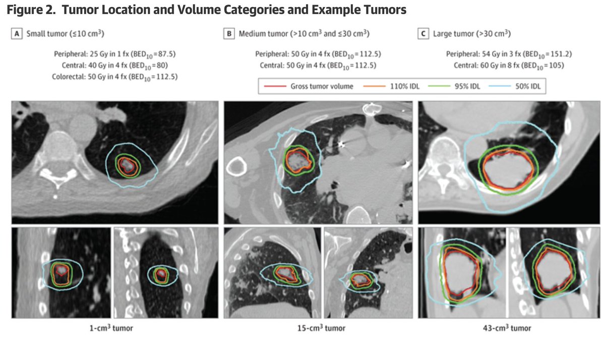 SCI members @max_diehn, @BLoo_LT_SABR, and others found individualized SABR used to treat #LungCancers may allow minimization of treatment dose and may be associated with excellent local control and a low rate of toxic effects. bit.ly/3tmwqfY