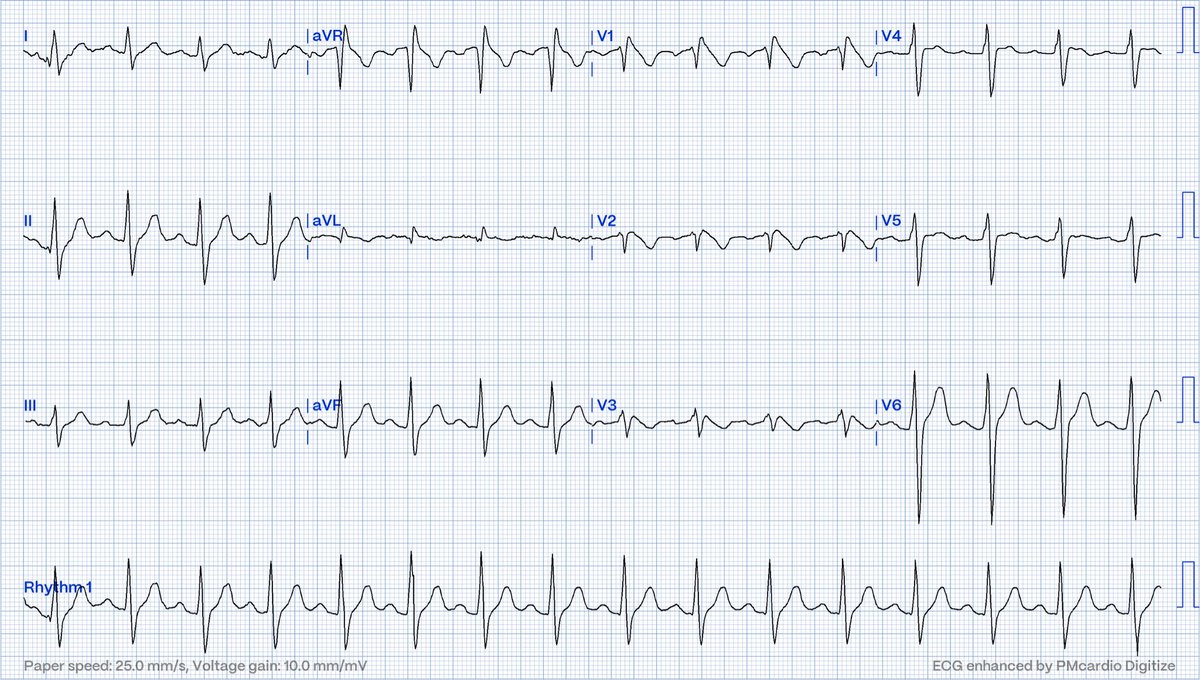 Interesting case: 13 yrs old, SCA while changing (afebrile but decreased appetite x 2 days), ecg (1) - rsR’ (even at high leads). Genetics SCN5A (c.1700T>A). Dad (2 siblibgs SCD) ecg (2), flecainide challenge test (3). Without genetic testing diagnosis would never had been made