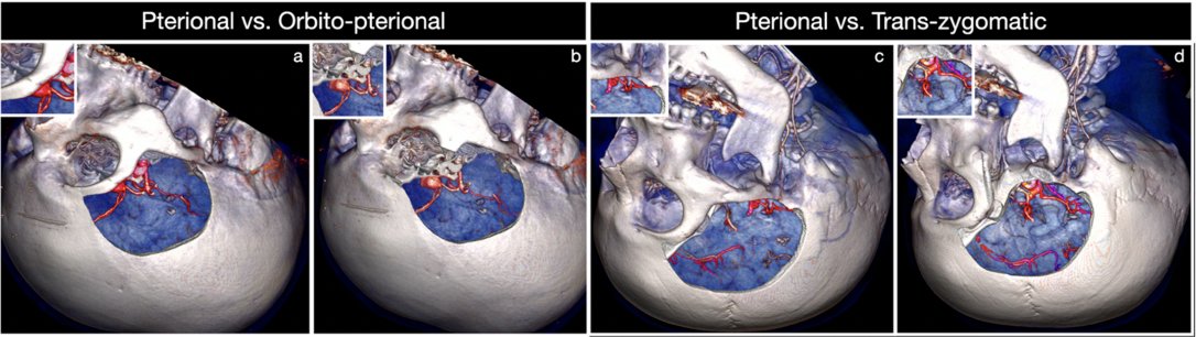 Which extended anterolateral approach do you prefer for clipping complex aneurysms? Which approach do you use for which type of aneurysm (ACOM, Basilar/SCA, ICA Terminus/PCOM, ophthalmic/paraclinoid), and why? Comment, share, repost and let us know!