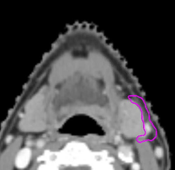 David Sher (@davidshermd) on Twitter photo <a href="/PBlanchardMD/">Pierre Blanchard, MD</a> I draw something similar, but less anterior. On a node-positive neck in OPC, I just treat the IB nodal tissue anterior to IIA, but not going more anterior than the anterior aspect of the gland. Also feel sparing IB entirely is reasonable (this splits the difference). <a href="/PBlanchardMD/">Pierre Blanchard, MD</a> I draw something similar, but less anterior. On a node-positive neck in OPC, I just treat the IB nodal tissue anterior to IIA, but not going more anterior than the anterior aspect of the gland. Also feel sparing IB entirely is reasonable (this splits the difference).