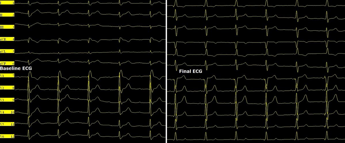 Giovanni Coluccia (@messapus) on Twitter photo How to correct 1st degree AVB & RBBB? With BI #LBBAP!😉78M w/presyncope and parox adv AVB. #Epeeps what about the different QRS morphology/axis btw nsLBB capture in UNI and in low-output BI config? <a href="/MdHuang/">Weijian Huang</a> <a href="/Marek_Jastrz_EP/">Marek Jastrzębski</a> <a href="/OCanoPerez/">Óscar Cano</a> <a href="/curilakarol/">curilakarol</a> <a href="/micogriecomd/">micogriecomd</a> And Happy Xmas!🎄 How to correct 1st degree AVB & RBBB? With BI #LBBAP!😉78M w/presyncope and parox adv AVB. #Epeeps what about the different QRS morphology/axis btw nsLBB capture in UNI and in low-output BI config? <a href="/MdHuang/">Weijian Huang</a> <a href="/Marek_Jastrz_EP/">Marek Jastrzębski</a> <a href="/OCanoPerez/">Óscar Cano</a> <a href="/curilakarol/">curilakarol</a> <a href="/micogriecomd/">micogriecomd</a> And Happy Xmas!🎄
