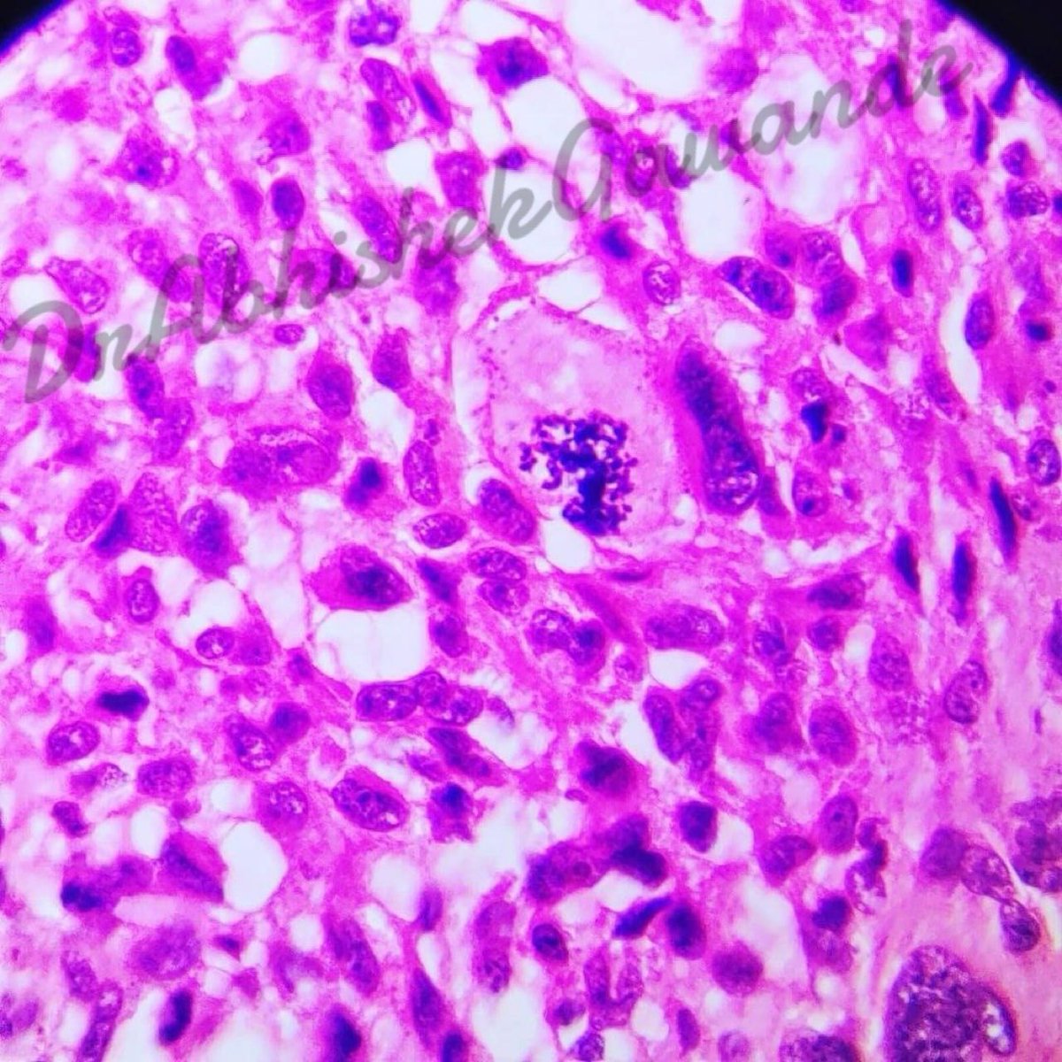 Atypical Mitosis’ in a monstrous cell. High grade Glioma (Glioblastoma Multiforme GBM), captured from my iPhone 14proMax!
#neuropathology #Oncopathology #mitosis #highgradeglioma #gbm #innovation #creativity #iphone14promax #iphonephotography #100xmagnification