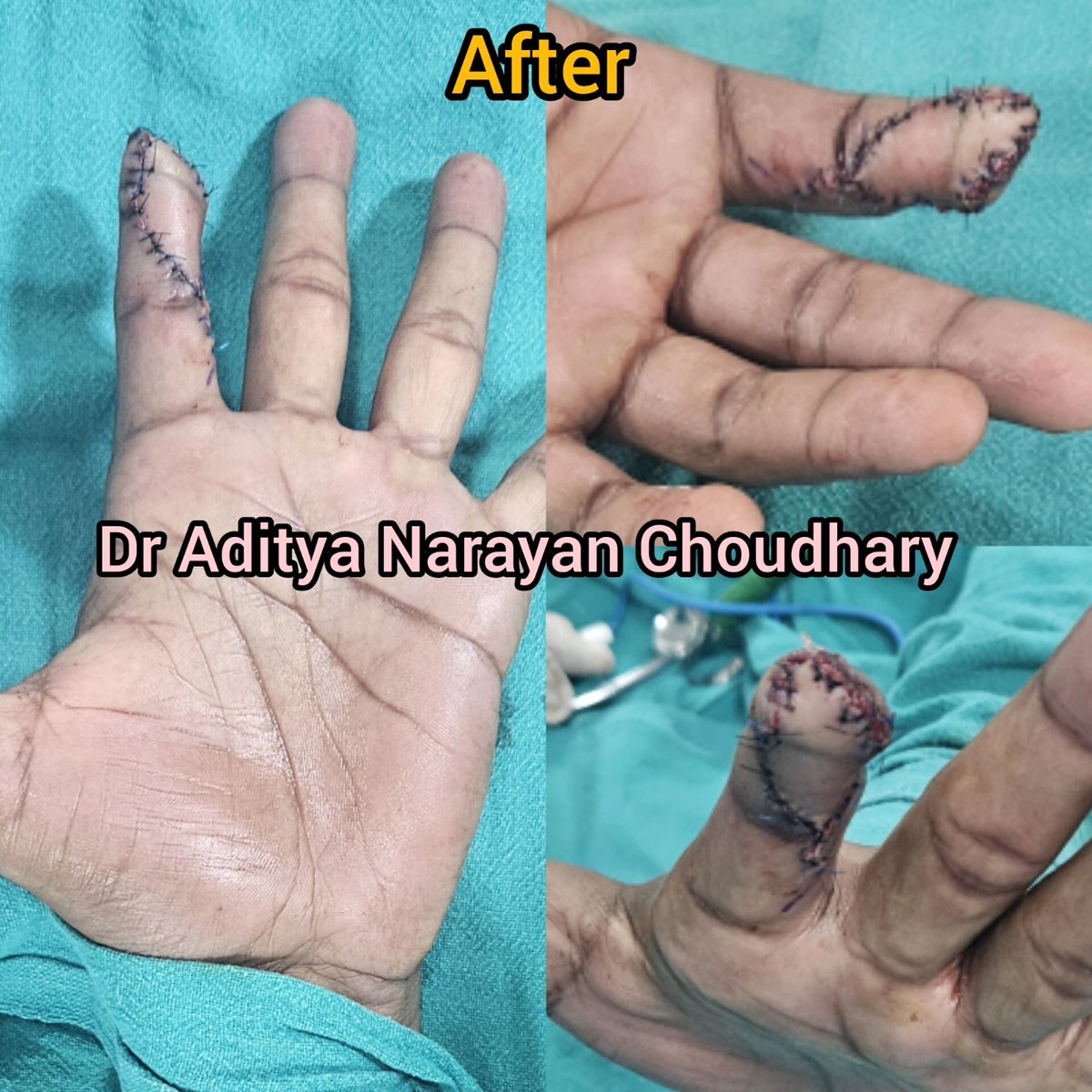 Performed an oblique triangular neurovascular homodigital island flap to address distal transection in the index finger. 🌟 Restoring function and aesthetics, one procedure at a time. #PlasticSurgery #HandReconstruction #MedicalMilestones #reconstructivesurgery #flaps