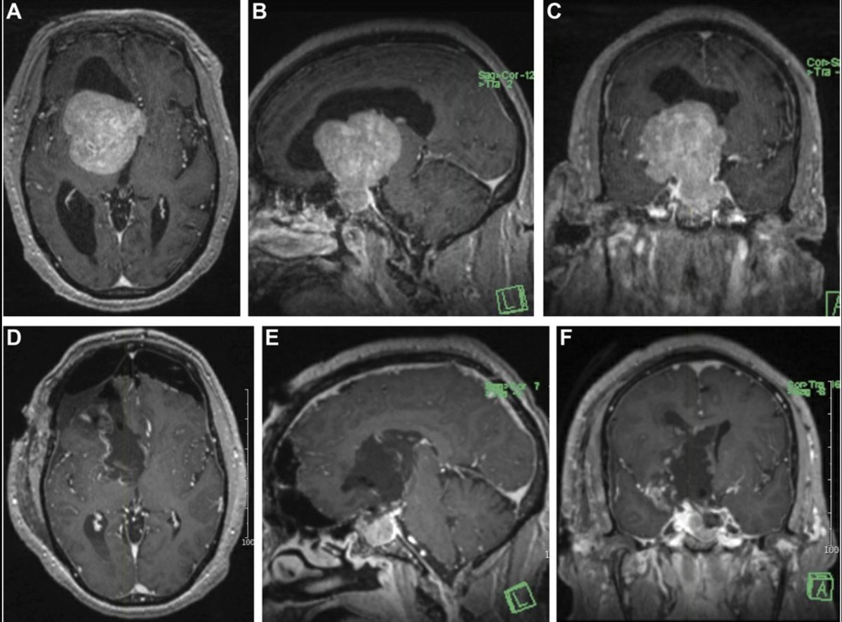 #ONSSectionEditorReviewSeries Surgical Strategies in the Treatment of Giant Pituitary #Adenomas bit.ly/3GQ7now by <a href="/krishna5182/">Krishna C. Joshi</a> <a href="/RushMedical/">Rush University System for Health</a> <a href="/CNS_Update/">CNS</a> <a href="/DKondziolkaCNS/">Douglas Kondziolka</a> <a href="/Zaazoue/">Mohamed Zaazoue, MD, MSc, MBA</a> <a href="/e_celano/">Emma Celano</a> <a href="/MdOlabisi/">Olabisi Sanusi MD, FAANS</a>