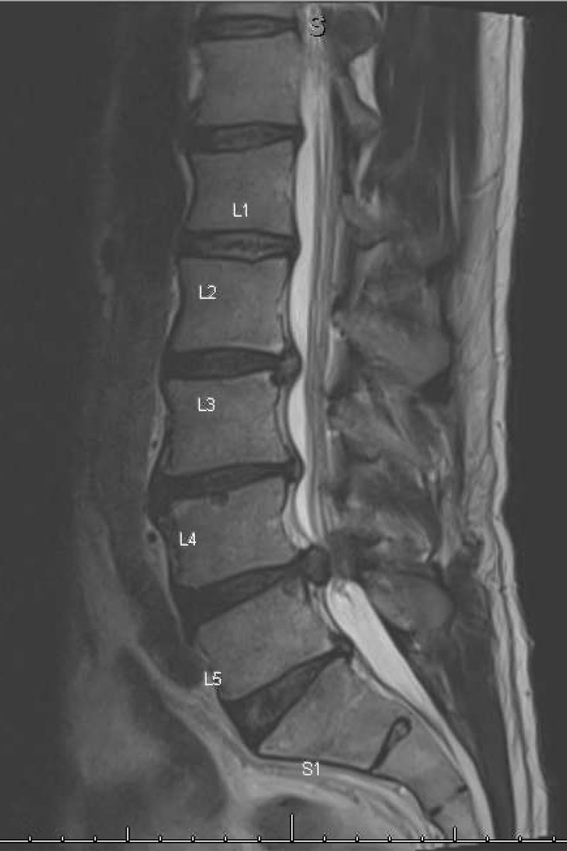 First transforaminal endoscopic microdiscetomy performed at <a href="/UPMC/">UPMC</a>. Carried out through a 7mm incision with discharge the next day, the approach minimizes unnecessary bone removal, post op pain, and nearly eliminates risk of infection. <a href="/js_hudson/">Joseph Hudson</a> <a href="/NitinAgarwalMD/">Nitin Agarwal, M.D.</a> <a href="/adlegarreta/">Andrew Legarreta</a>