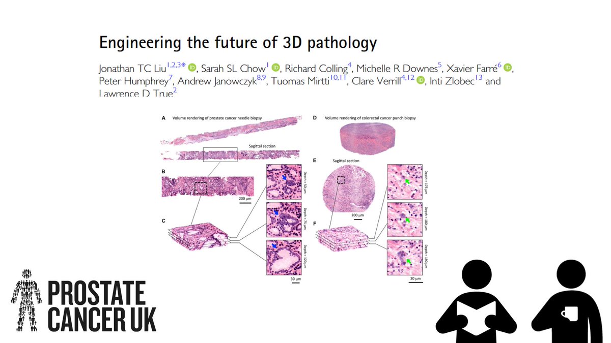 What role could 3D pathology play in the future of #prostatecancer diagnosis and treatment?🔬 Amazing collaborative effort by @OxfordBRC and global colleagues - showing some of the advantages and challenges of 3D pathology! Grab a ☕and click the link: bit.ly/3v7Spb6