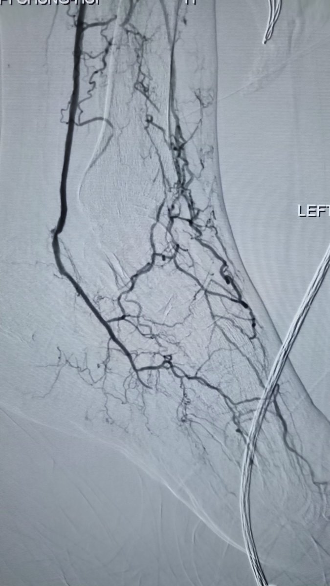 Distal medial plantar artery retrograde access for recanalization of a PT and proximal medial plantar artery CTO. DP non-existent with only collaterals to foot. Planned for TMA.  #vascular #IRad #endovascular #limbsalvage #vascularsurgery #CLTI #CLTIfighters
